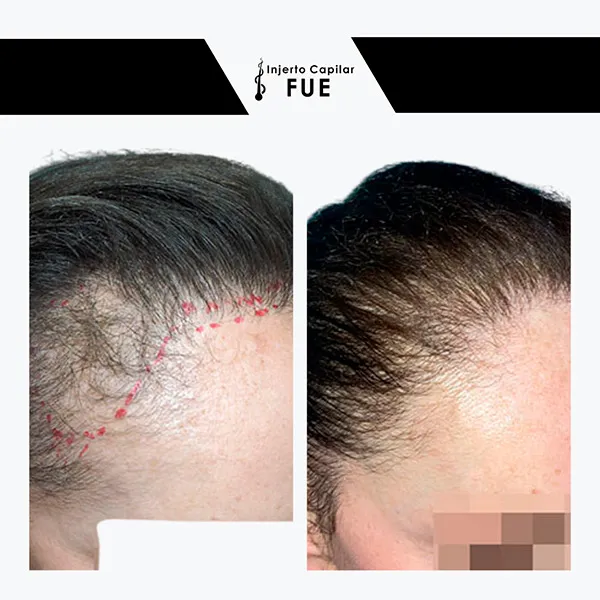 Antes y después de un tratamiento en la clínica