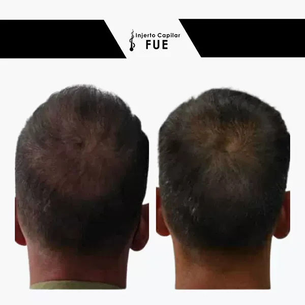 Antes y después de un tratamiento en la clínica