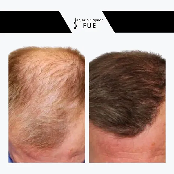 Antes y después de un tratamiento en la clínica