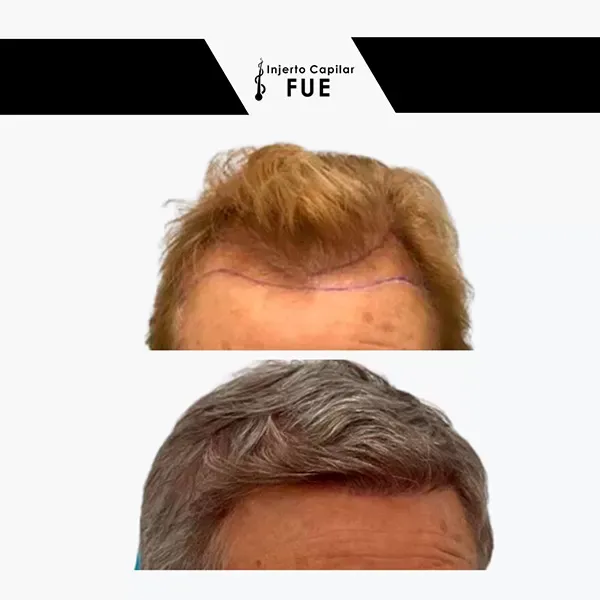 Antes y después de un tratamiento en la clínica