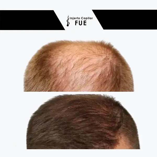 Antes y después de un tratamiento en la clínica