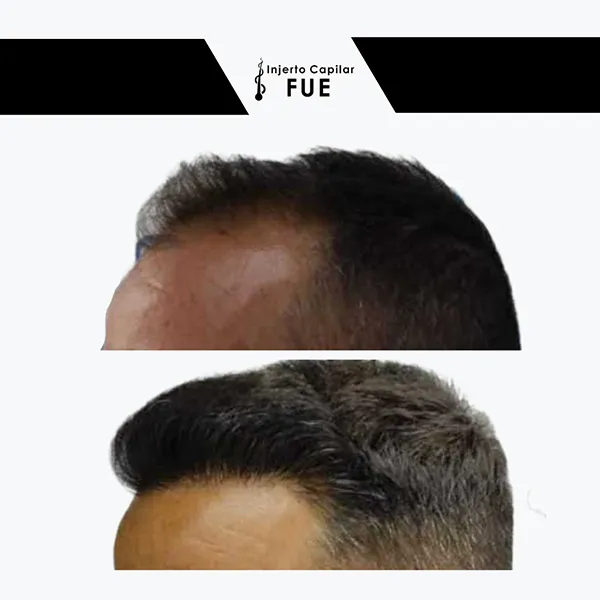 Antes y después de un tratamiento en la clínica