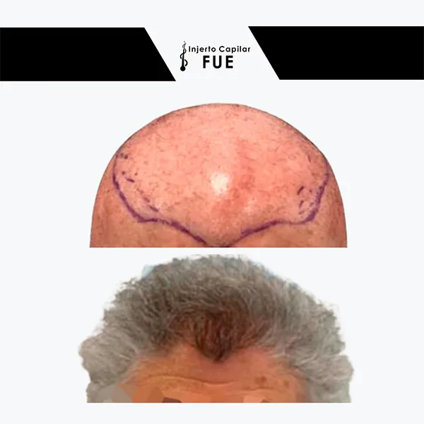 Antes y después de un tratamiento en la clínica