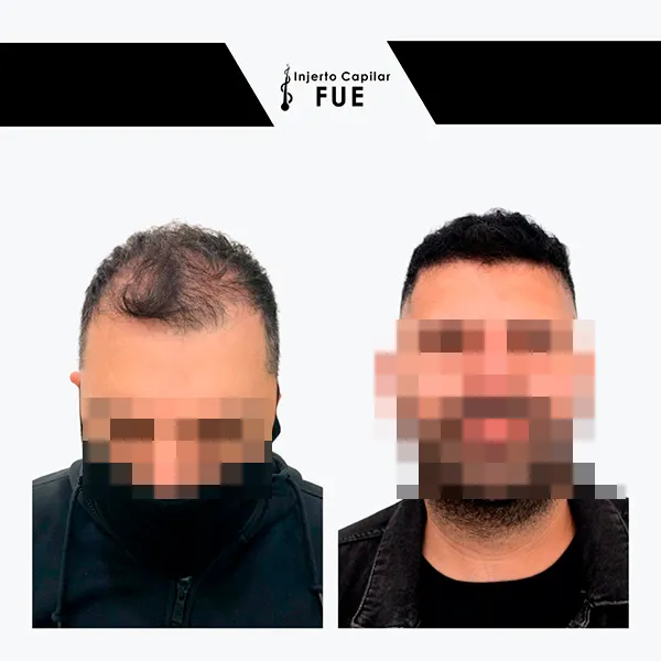 Antes y después de un tratamiento en la clínica