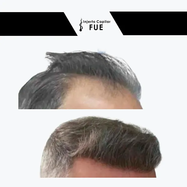 Antes y después de un tratamiento en la clínica