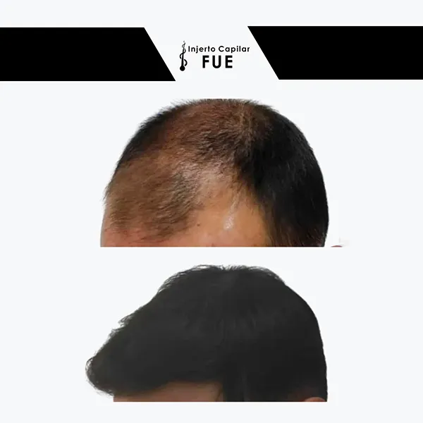 Antes y después de un tratamiento en la clínica
