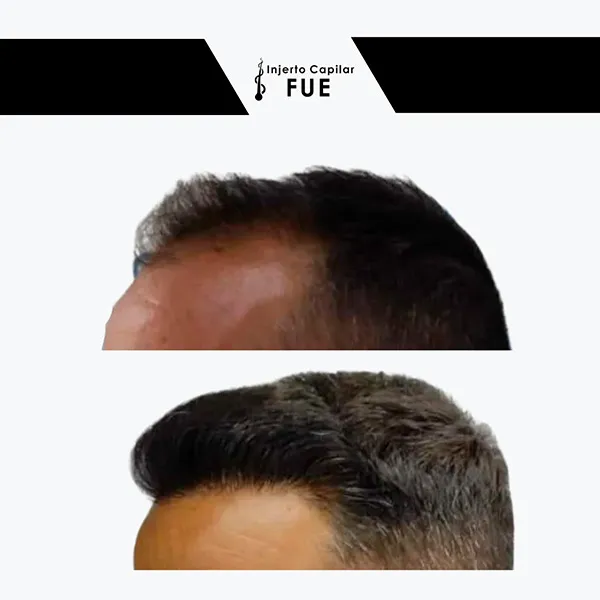 Antes y después de un tratamiento en la clínica