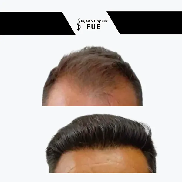 Antes y después de un tratamiento en la clínica