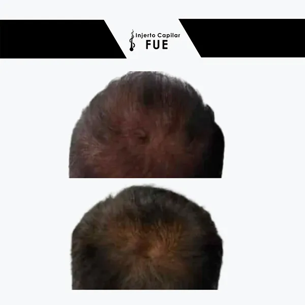 Antes y después de un tratamiento en la clínica