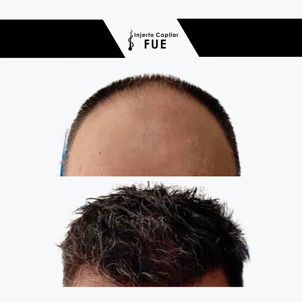 Antes y después de un tratamiento en la clínica