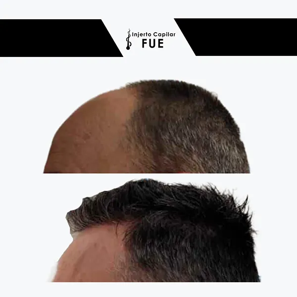 Antes y después de un tratamiento en la clínica
