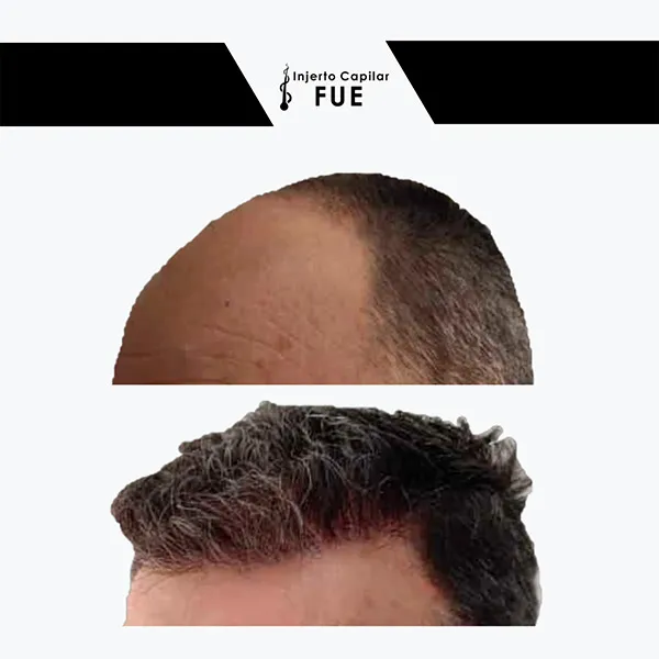 Antes y después de un tratamiento en la clínica