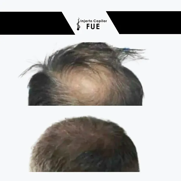 Antes y después de un tratamiento en la clínica