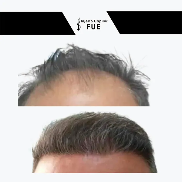 Antes y después de un tratamiento en la clínica
