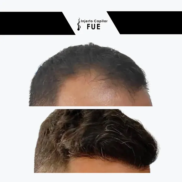 Antes y después de un tratamiento en la clínica