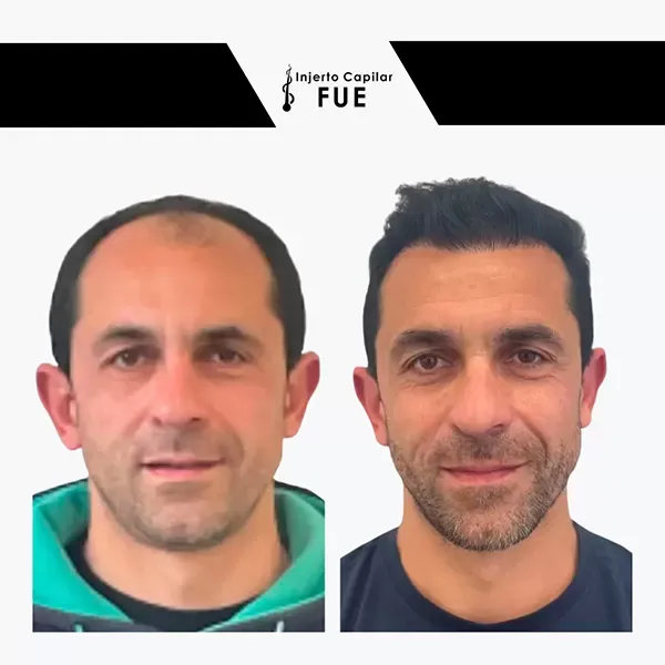 Antes y después de un tratamiento en la clínica