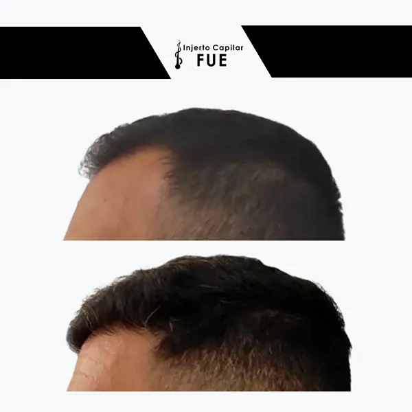 Antes y después de un tratamiento en la clínica