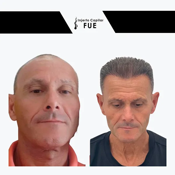 Antes y después de un tratamiento en la clínica