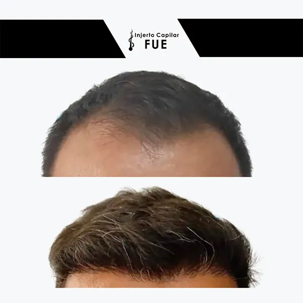 Antes y después de un tratamiento en la clínica