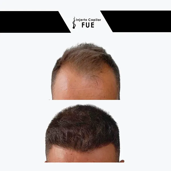 Antes y después de un tratamiento en la clínica