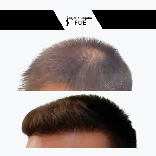 Antes y después de un tratamiento en la clínica