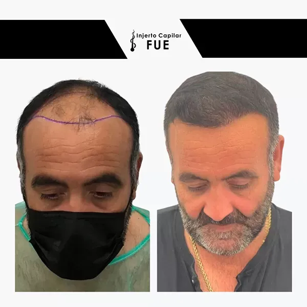 Antes y después de un tratamiento en la clínica