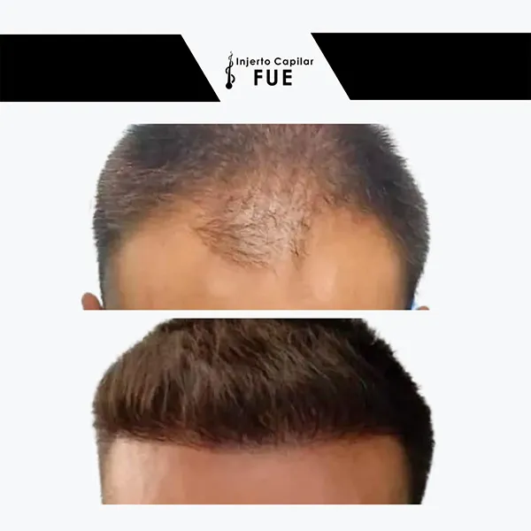 Antes y después de un tratamiento en la clínica