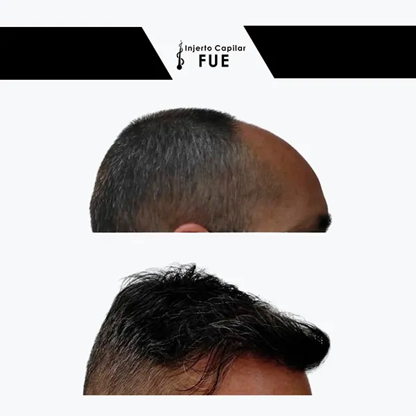 Antes y después de un tratamiento en la clínica