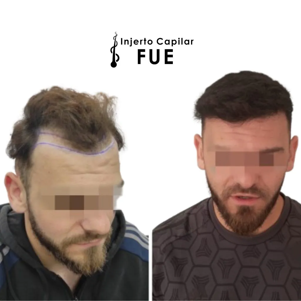 Antes y después de un injerto capilar FUE en la clínica