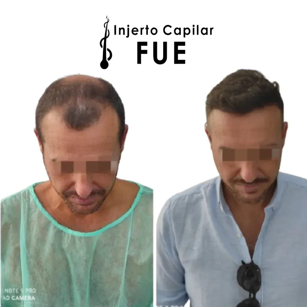 Antes y después de un injerto capilar FUE en la clínica