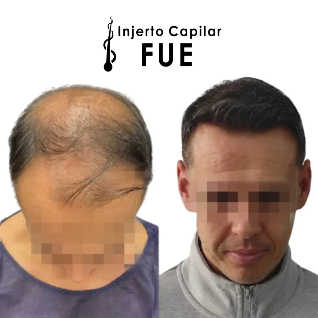 Antes y después de un injerto capilar FUE en la clínica