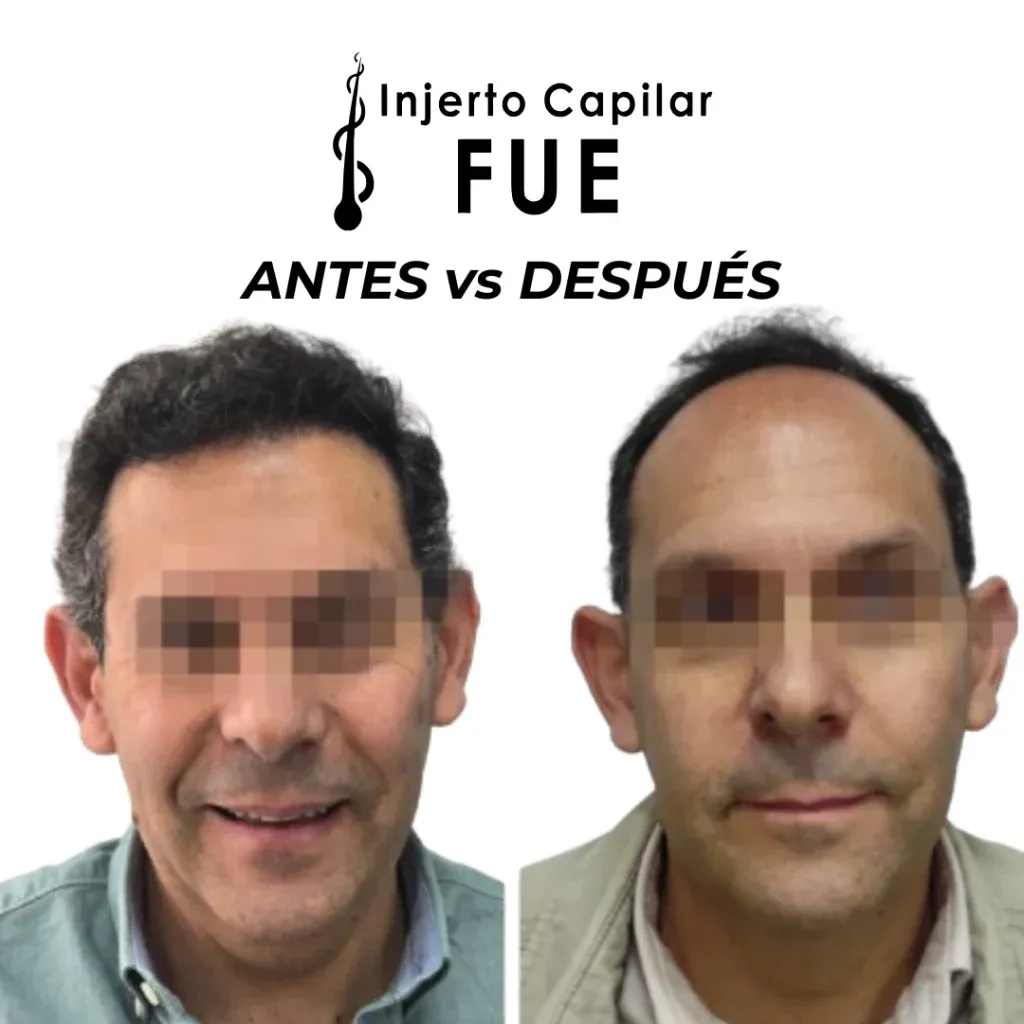 Antes y después de un injerto capilar FUE en la clínica