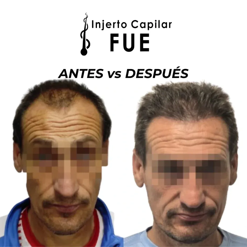 Antes y después de un injerto capilar FUE en la clínica