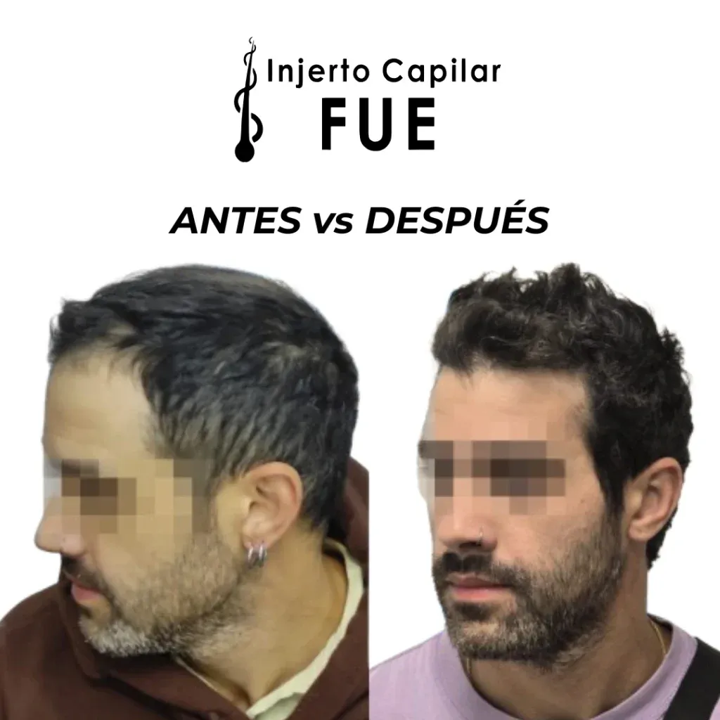 Antes y después de un injerto capilar FUE en la clínica