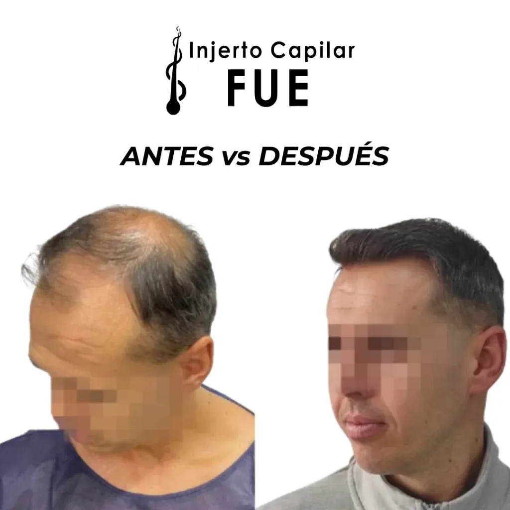 Antes y después de un injerto capilar FUE en la clínica