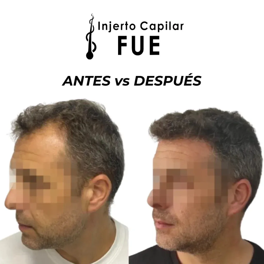 Antes y después de un injerto capilar FUE en la clínica