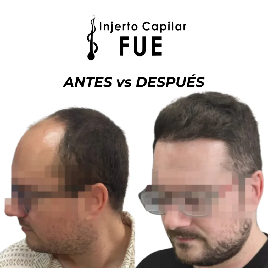 Antes y después de un injerto capilar FUE en la clínica