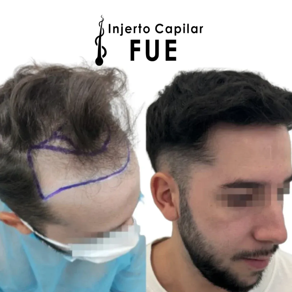 Antes y después de un injerto capilar FUE en la clínica