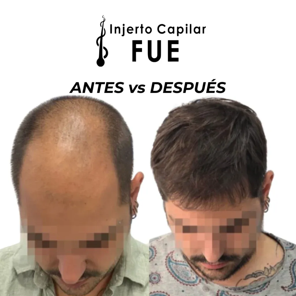 Antes y después de un injerto capilar FUE en la clínica