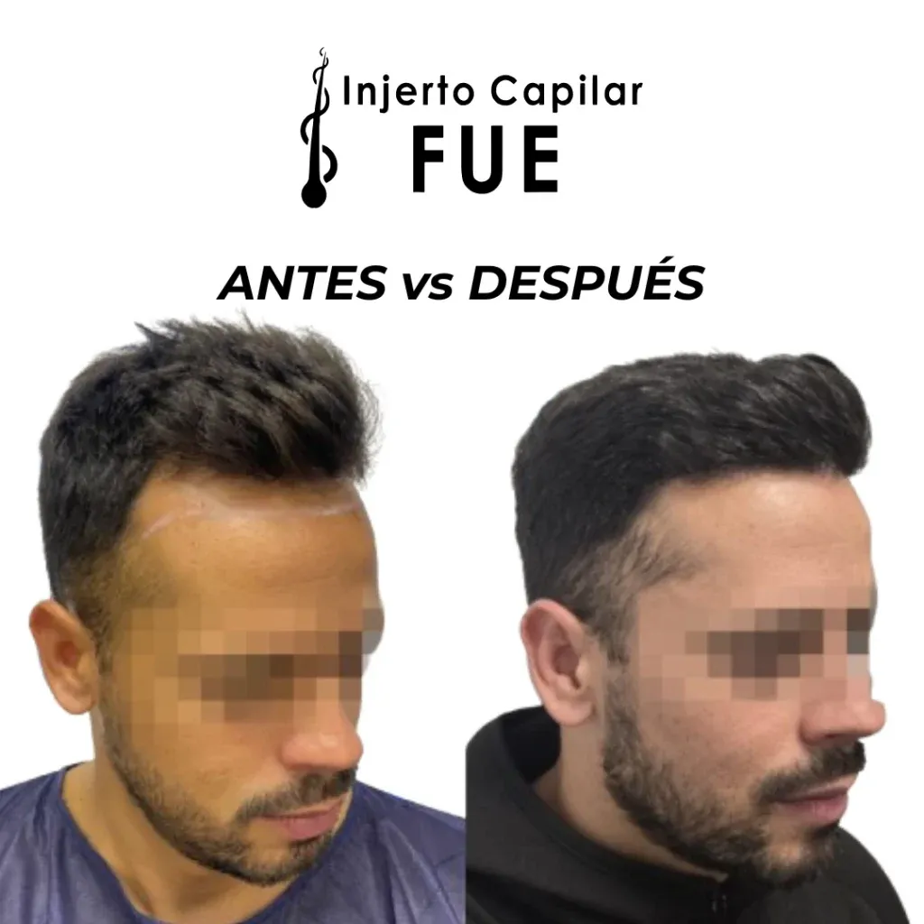 Antes y después de un injerto capilar FUE en la clínica