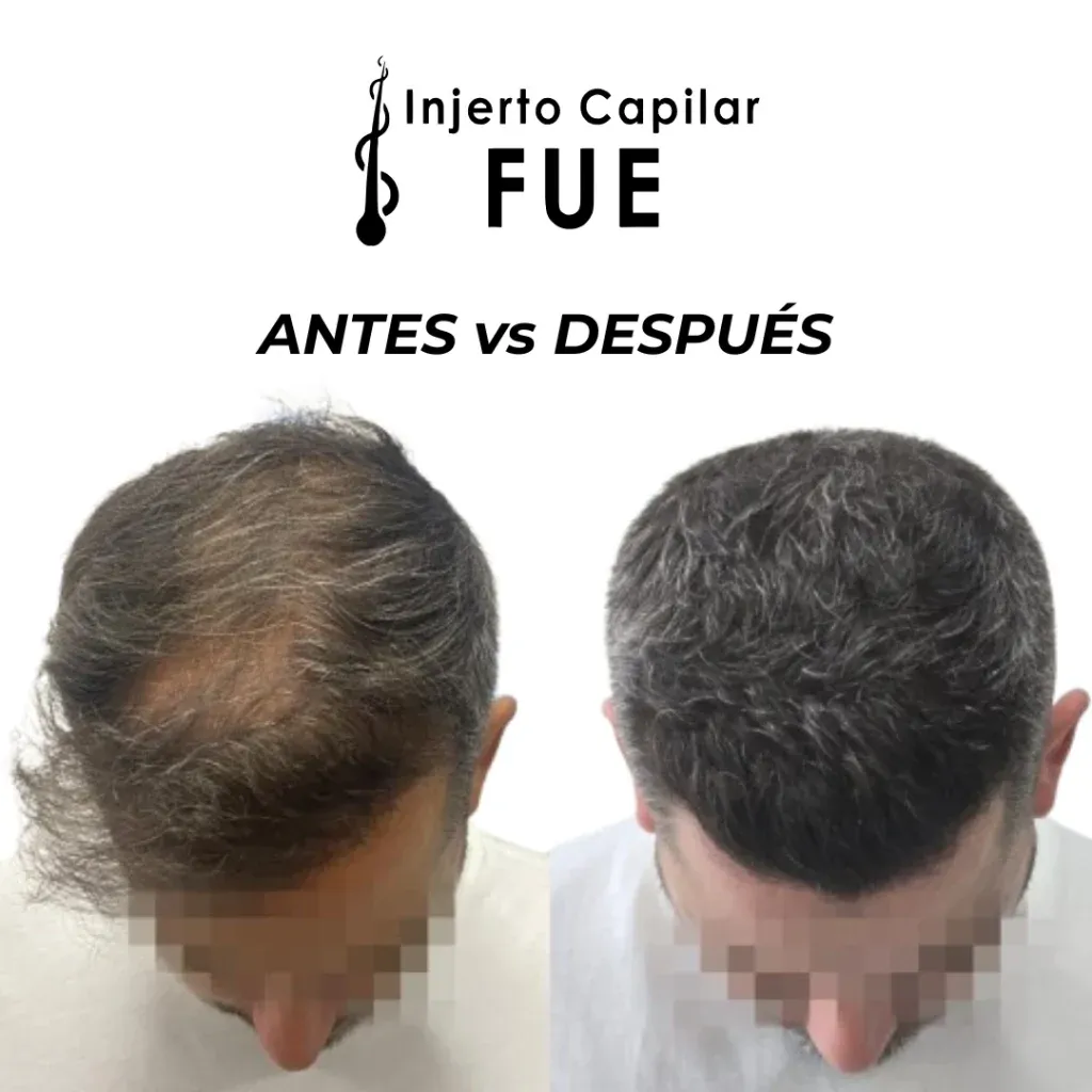 Antes y después de un injerto capilar FUE en la clínica