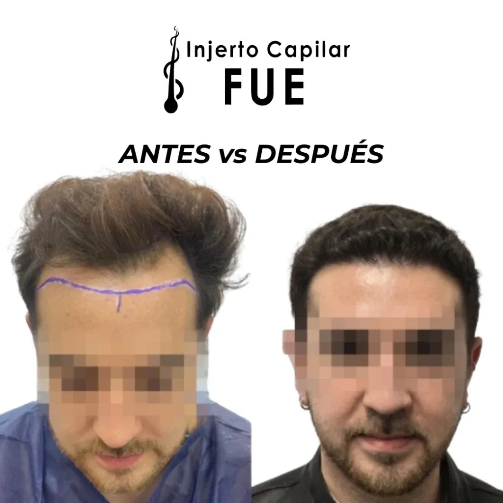 Antes y después de un injerto capilar FUE en la clínica