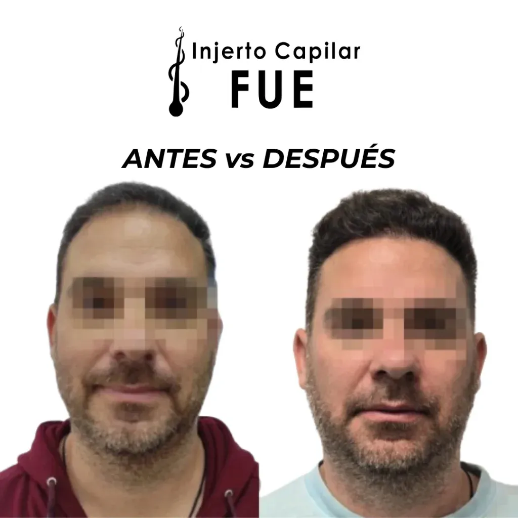 Antes y después de un injerto capilar FUE en la clínica