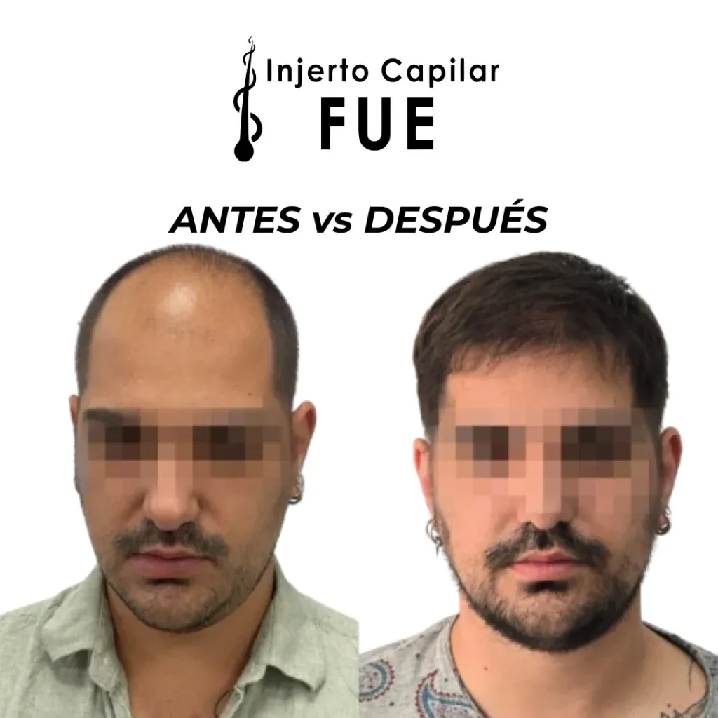 Antes y después de un injerto capilar FUE en la clínica