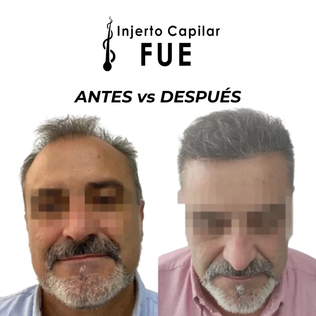 Antes y después de un injerto capilar FUE en la clínica