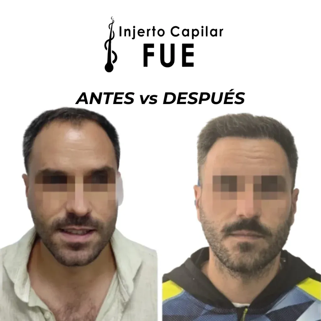 Antes y después de un injerto capilar FUE en la clínica