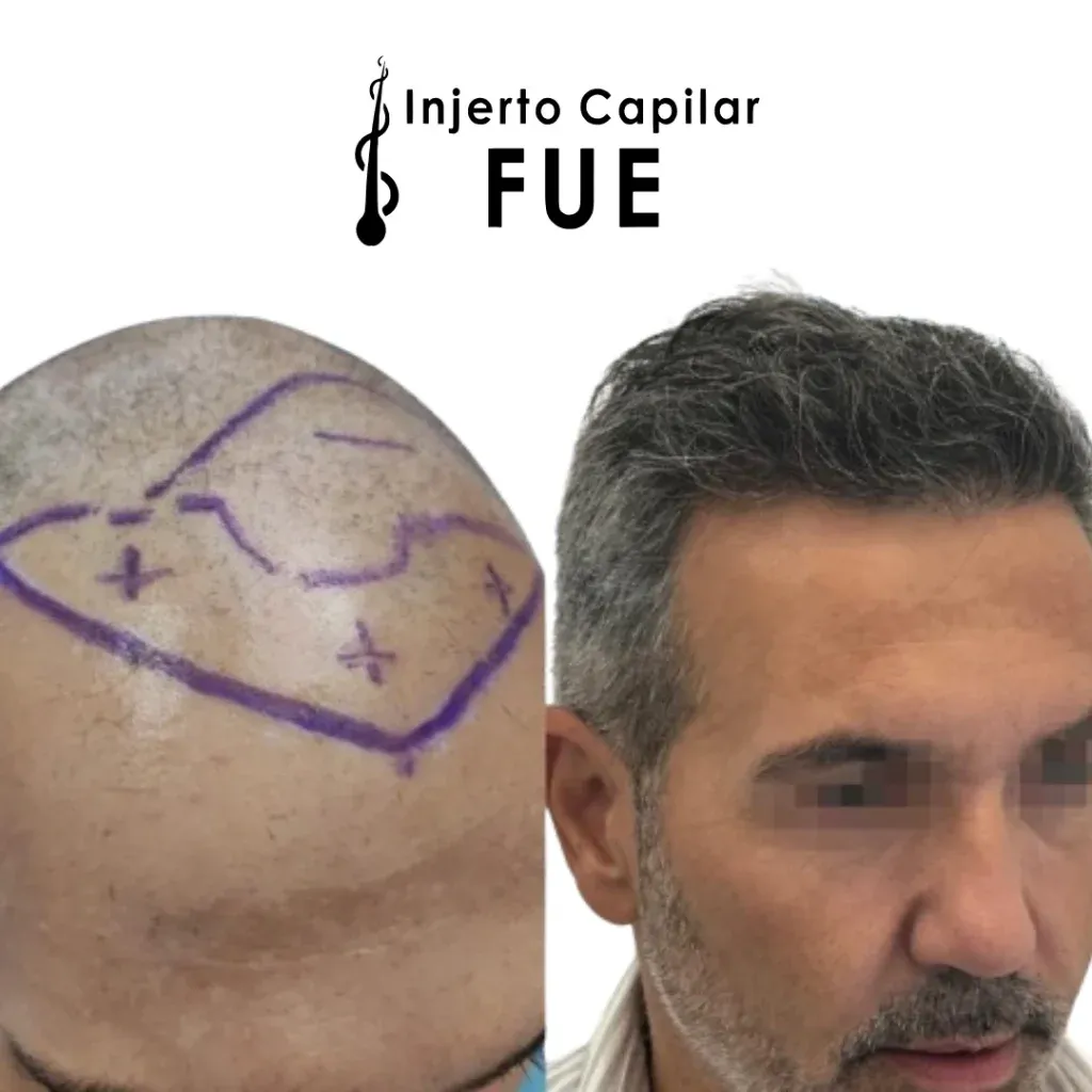 Antes y después de un injerto capilar FUE en la clínica