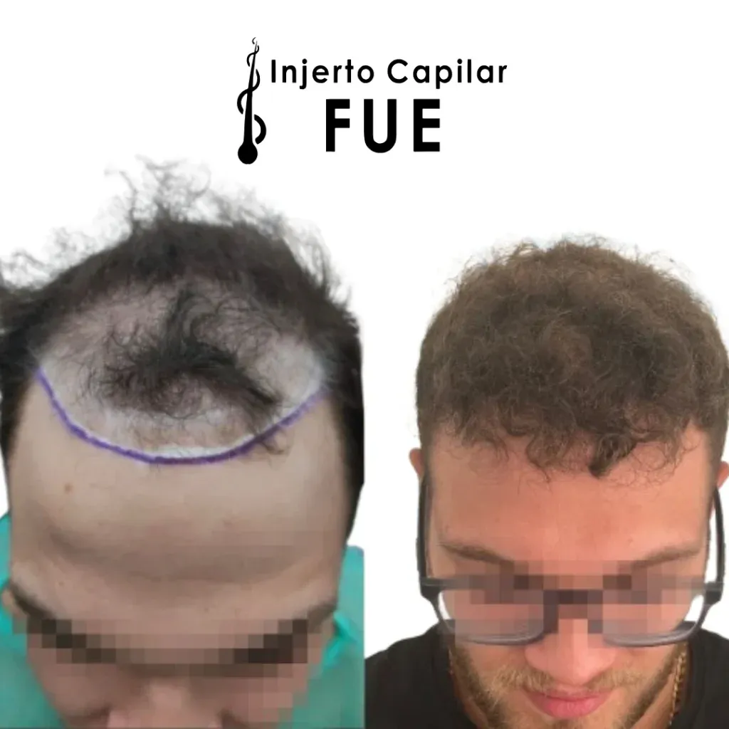 Antes y después de un injerto capilar FUE en la clínica