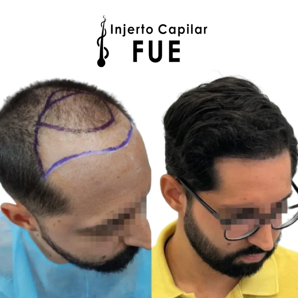 Antes y después de un injerto capilar FUE en la clínica