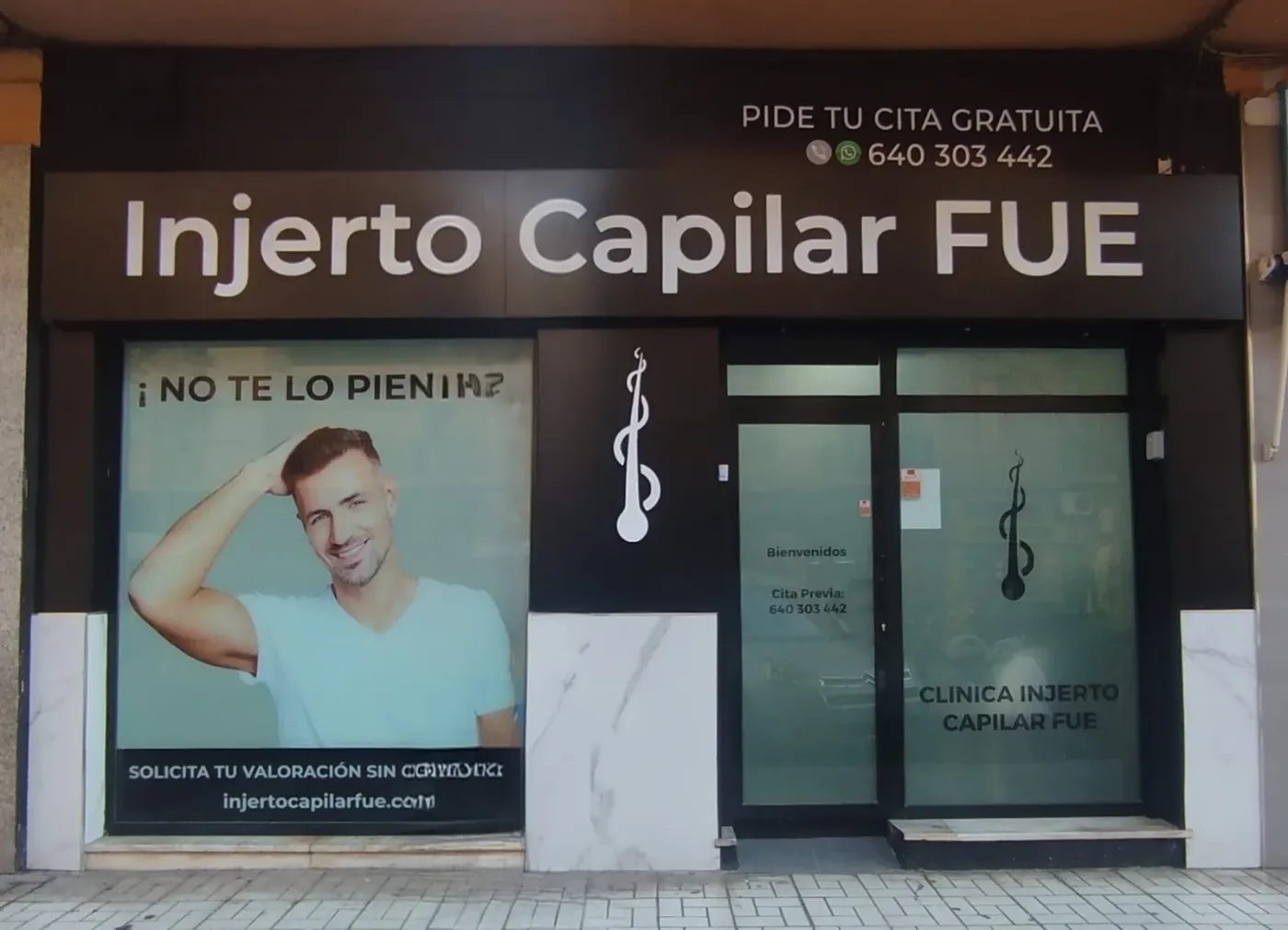 Implante de Pelo en Málaga con Técnica FUE